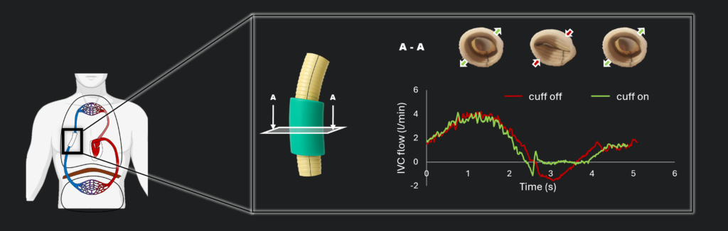 Diagram showing a cuff device on the inferior vena cava and a graph comparing IVC blood flow over time with the cuff off versus on